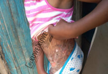 ABANDONED: 8-year-old girl needs skin grafting, pleads for medical financial aid