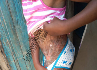 ABANDONED: 8-year-old girl needs skin grafting, pleads for medical financial aid